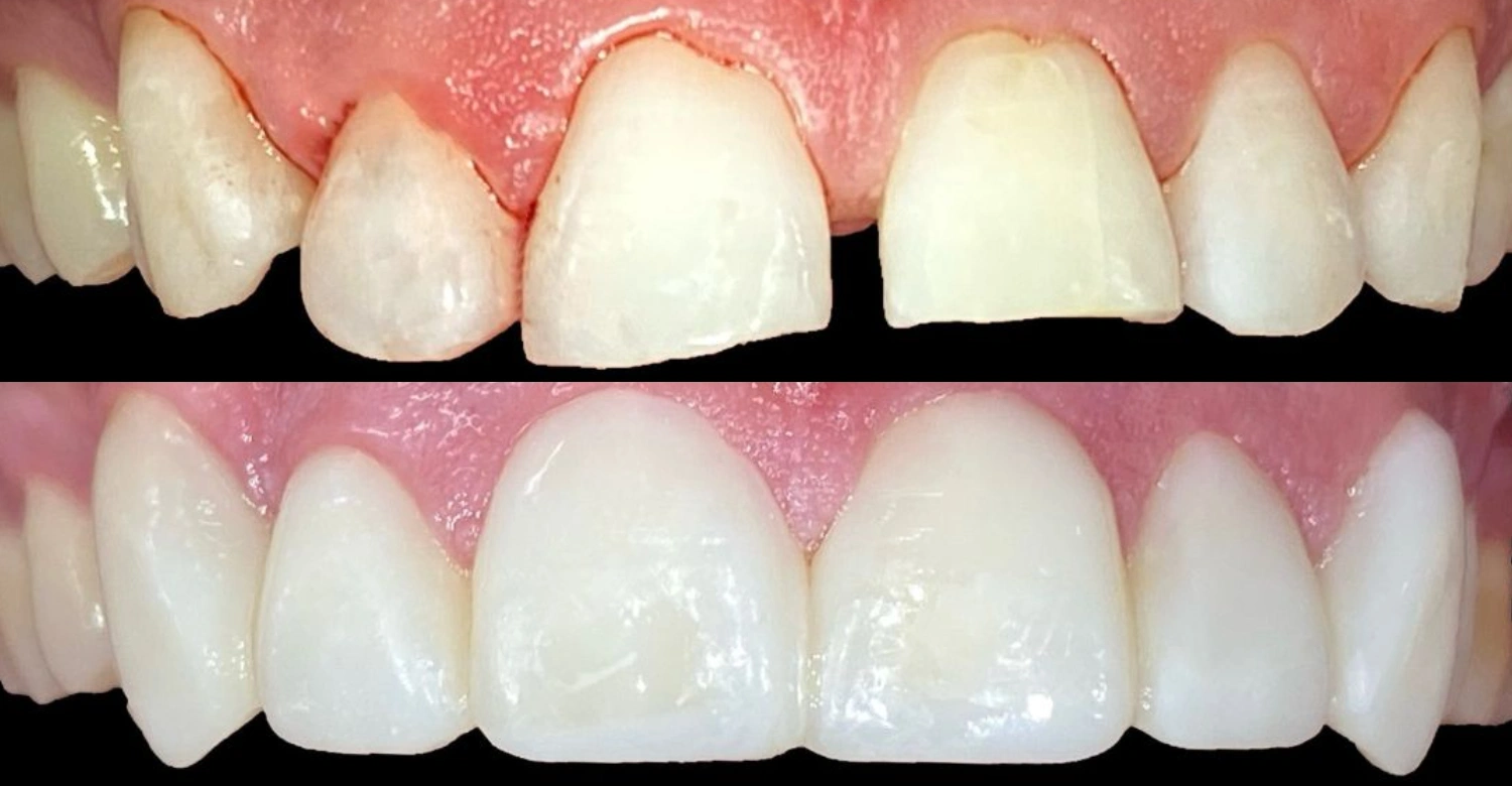 Composite Bonding in Turkey Inblog